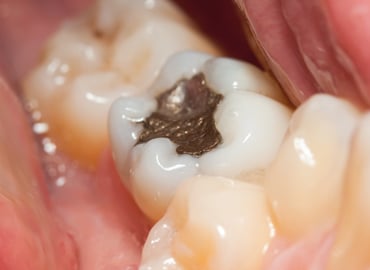 The controversy surrounding dental amalgam (“silver fillings”)