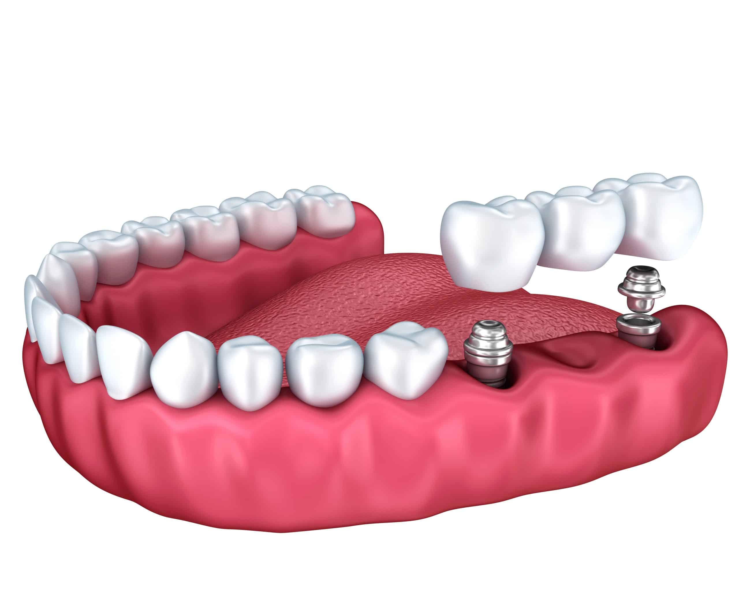 Tooth Replacement In Toronto