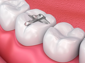 Restorative Dentistry In Toronto